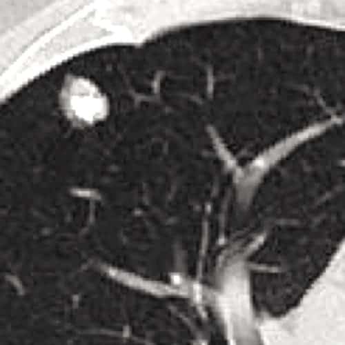 nodule pulmonaire solitaire actualites cytoponction echographie doppler imagerie paris 13 radiologie irm scanner radiographie echographie doppler osteodensitometrie senologie infiltration paris 13 2